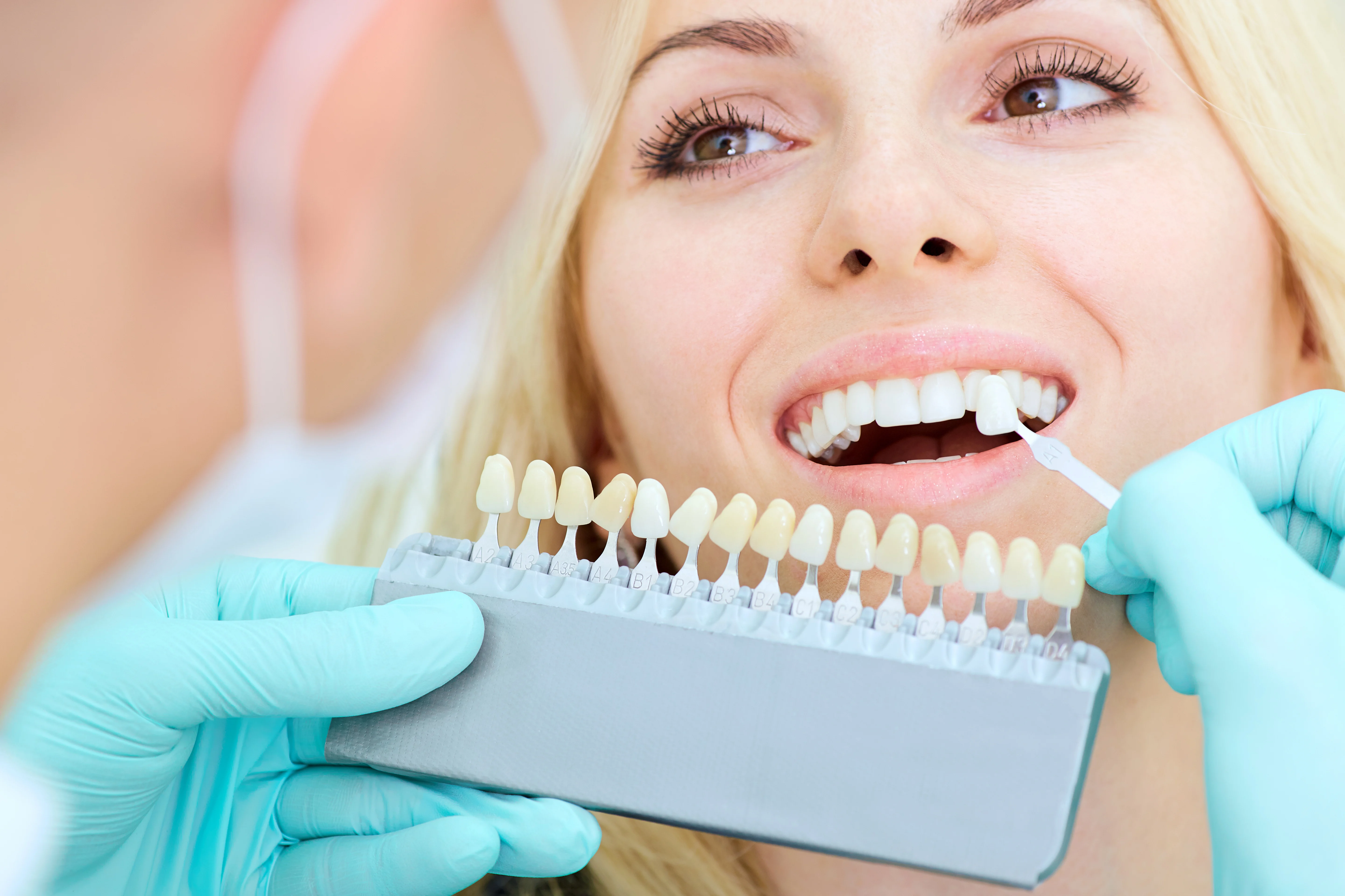 Teeth whitening